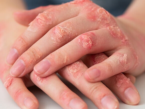 Imagem das mãos de uma pessoa com lesões avermelhadas devido a disidrose