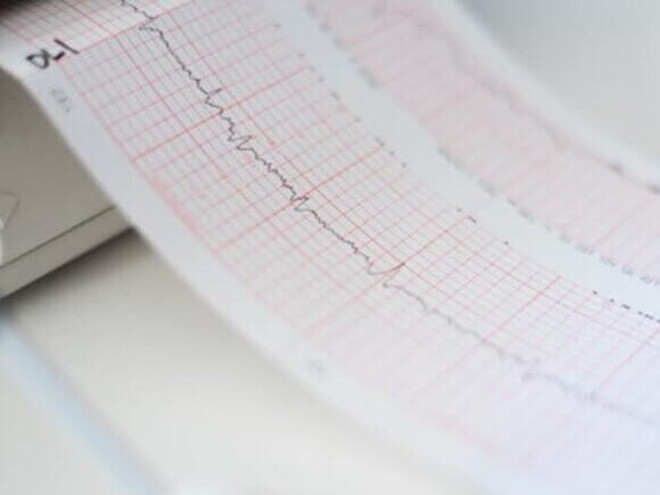 Cardiograma sendo impresso durante exame