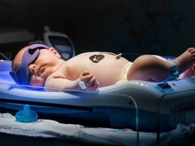 Recém-nascido passando por um procedimento de fototerapia neonatal.