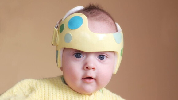 Um bebê utilizando uma órtese craniana, popularmente conhecida como "capacete"