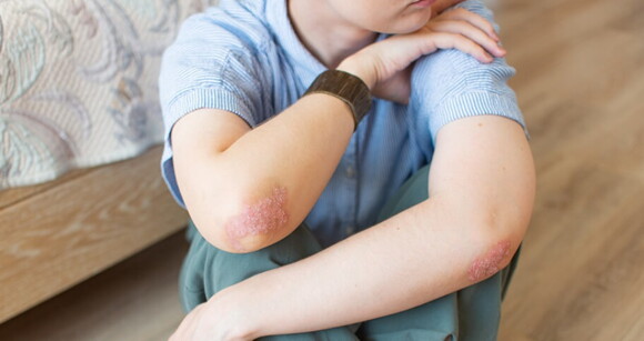 Criança sentada no chão com erupções cutâneas no braço causada pela escarlatina