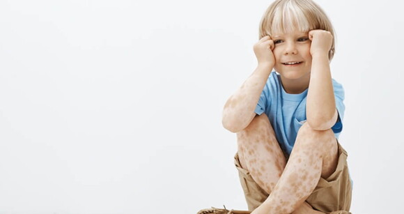 Foto de uma criança com manchas de vitiligo pelo corpo