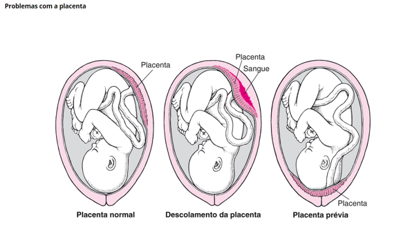 problemas com a placenta