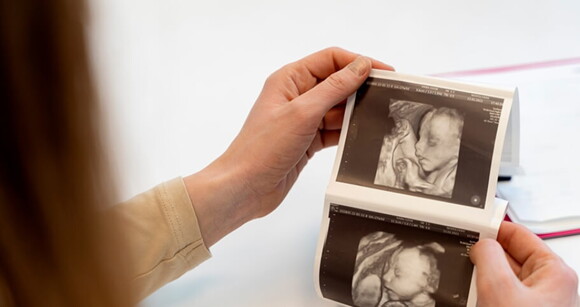 Mulher segurando imagens de ultrassonografia neonatal de bebê com Síndrome de Patau.